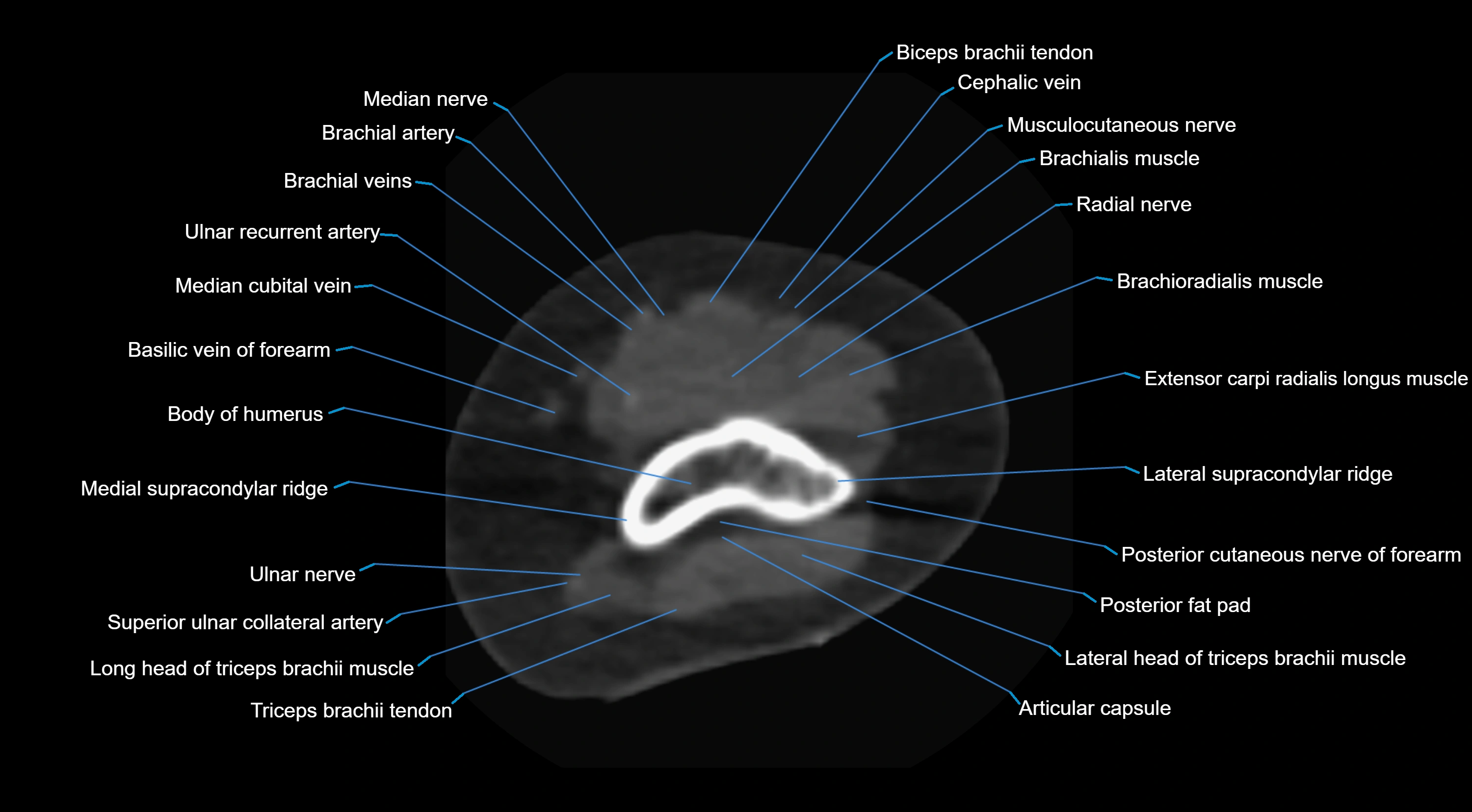 CT elbow axial  cross sectional anatomy labelled  radiology image -00010.webp